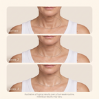Glass Neck Hydrogel Patch